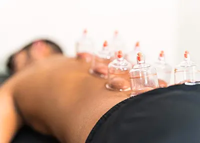 Dry cupping treatments in Dublin